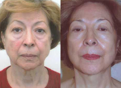 Így tüntettem el a táskákat a szemem alól szódabikarbóna segítségével